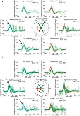 Vestibular and Ocular Motor Properties in Lateral Medullary Stroke Critically Depend on the Level of the Medullary Lesion